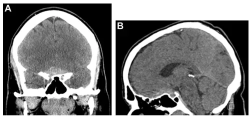 腦膜瘤案例圖片